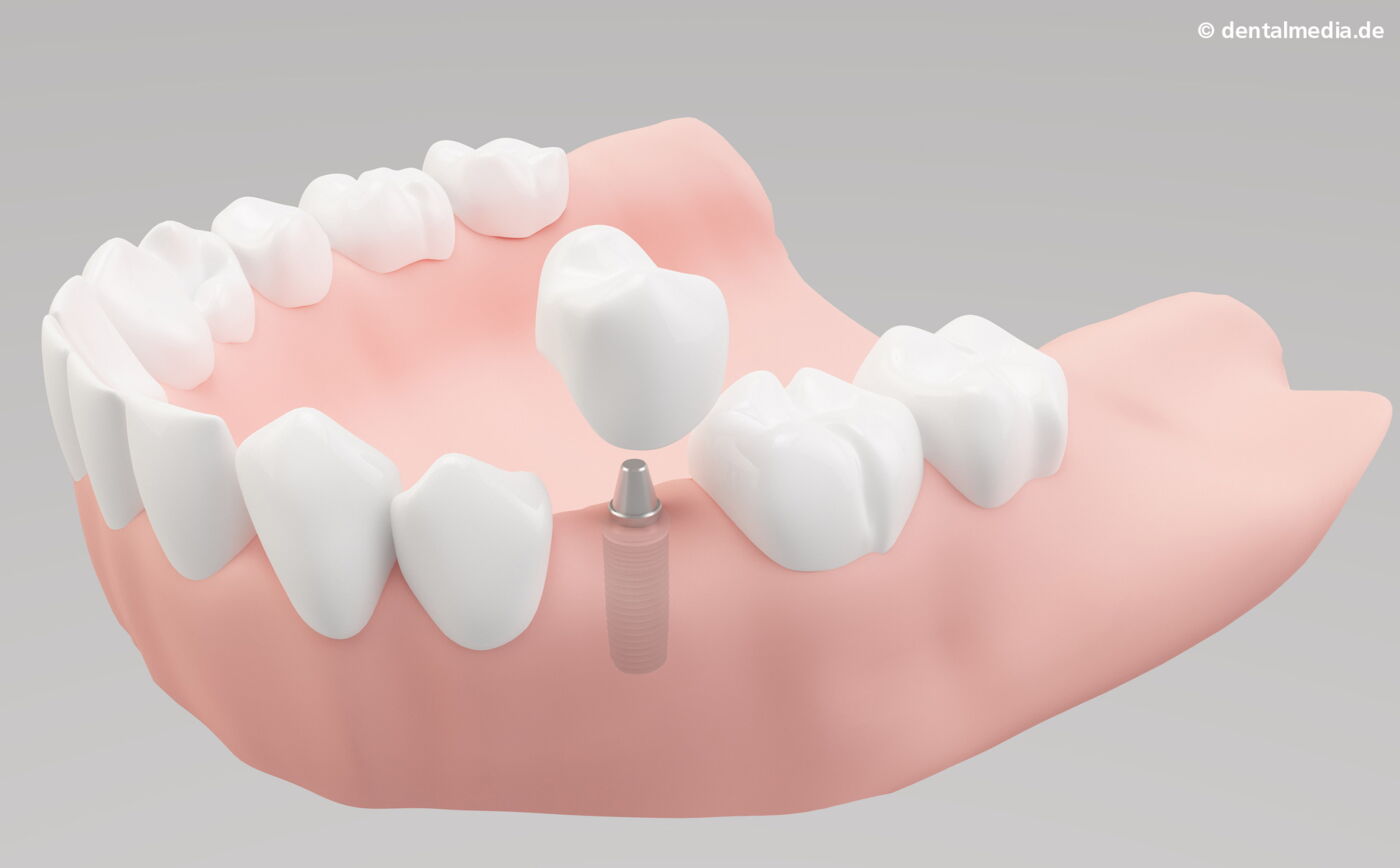 Ein Zahn fehlt. Ein Implantat hat gegenüber einer Brücke den Vorteil, dass Nachbarzähne nicht beschliffen werden müssen.